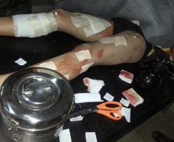 من مفارقات الغوطة الغربية.. طبيب أسنان يقوم بإجراء ولادة قيصرية