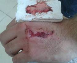 في سبيل العودة إلى تركيا.. أسلاك اليونان الشائكة تترك أثراً لا ينسى على يد 