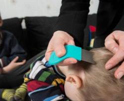 القمل.. مشكلة تؤرق رؤوس السوريين في أوروبا